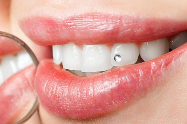 Zahnschmuck - Ästhetische Akzente für Ihr Lächeln